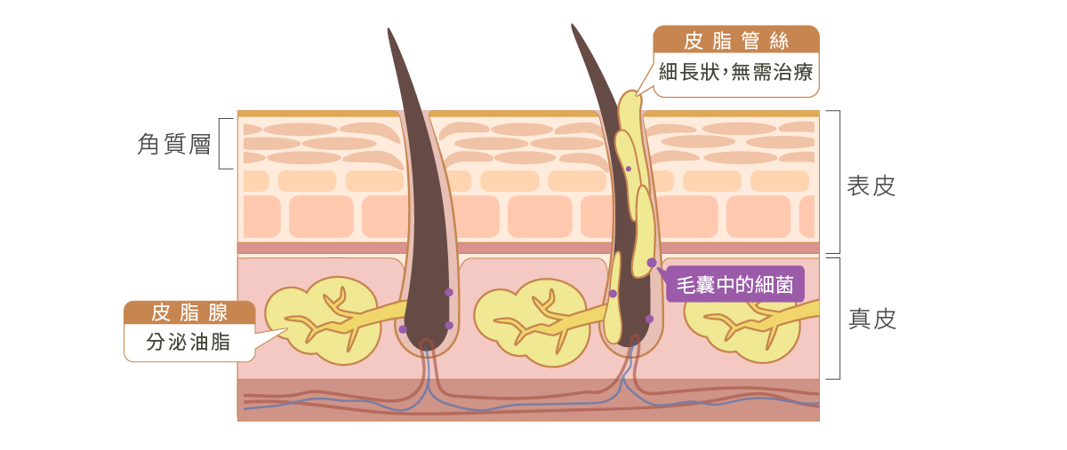 皮脂管絲與粉刺的差異