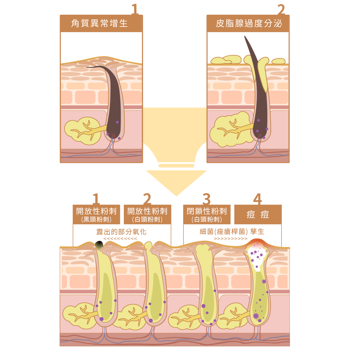 皮脂管絲與粉刺的差異