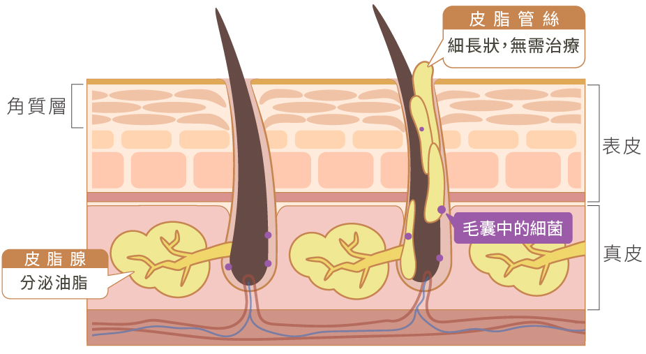 皮脂管絲與粉刺的差異