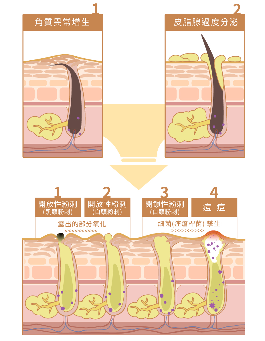 皮脂管絲與粉刺的差異