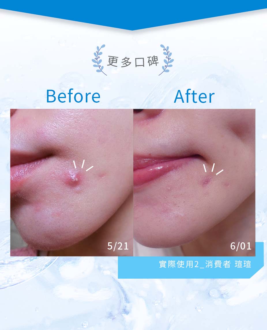簡單保養淨痘精華AB