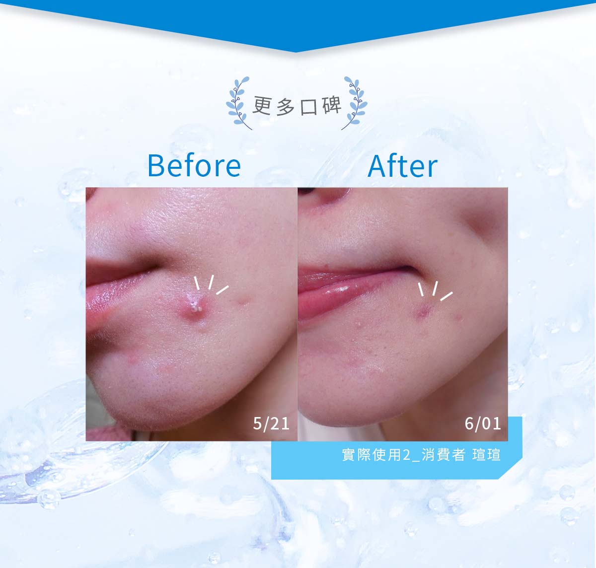 簡單保養淨痘精華AB