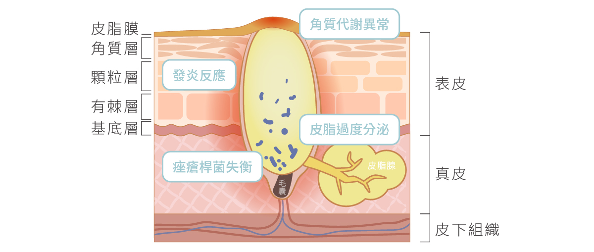 青春痘(痤瘡/面皰/粉刺/暗瘡)的成因與類型 - Simplism簡單保養