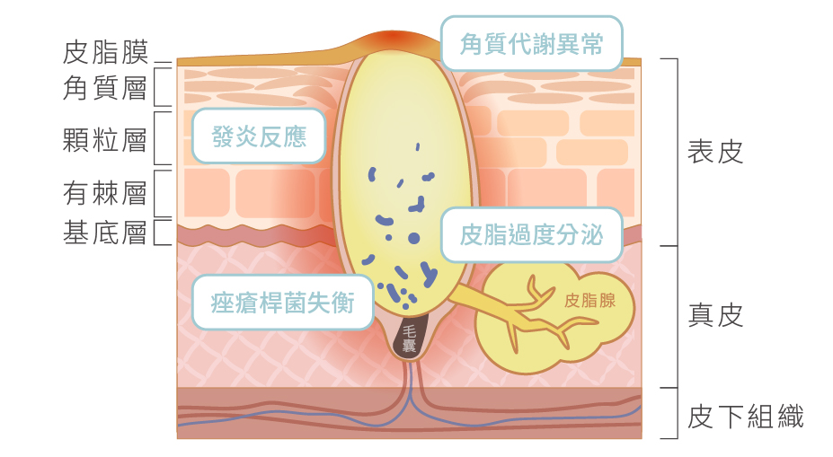 青春痘(痤瘡/面皰/粉刺/暗瘡)的成因與類型 - Simplism簡單保養